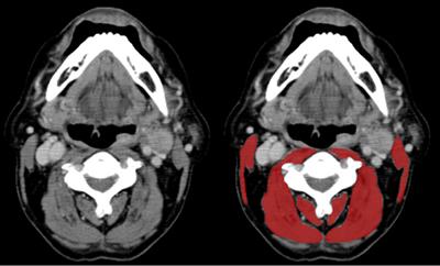 Sarcopenia accompanied by systemic inflammation can predict clinical outcomes in patients with head and neck cancer undergoing curative therapy